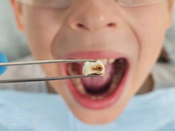 Best Emergency Tooth Extraction  in Calcutta, OH